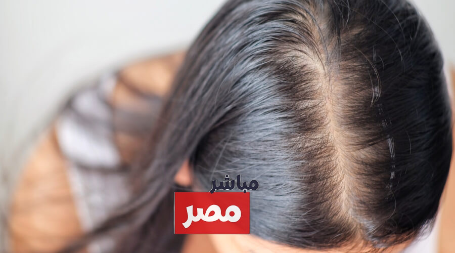 متى يكون تساقط الشعر خطير