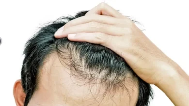 متى يكون تساقط الشعر خطير