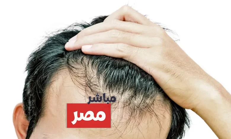 متى يكون تساقط الشعر خطير